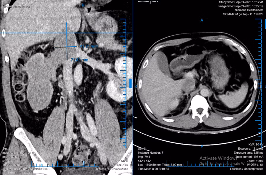 Hình ảnh khối ung thư biểu mô tế bào thận có huyết khối bướu trên phim CT-scan của người bệnh. (Ảnh: BVCC)