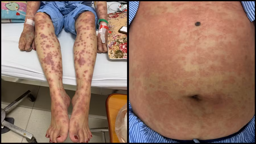 Các nốt đỏ xuất hiện trên người bệnh nhân. 