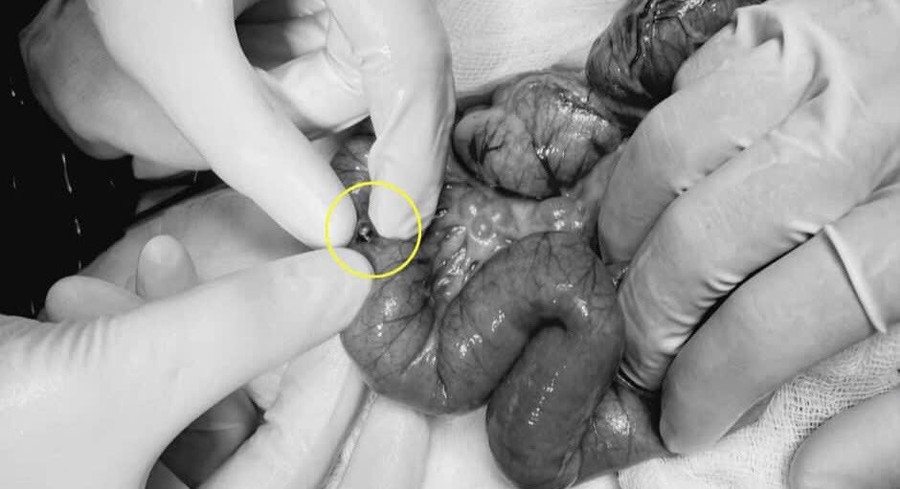 Các bác sĩ thực hiện lấy viên bi ra khỏi ruột bệnh nhi.