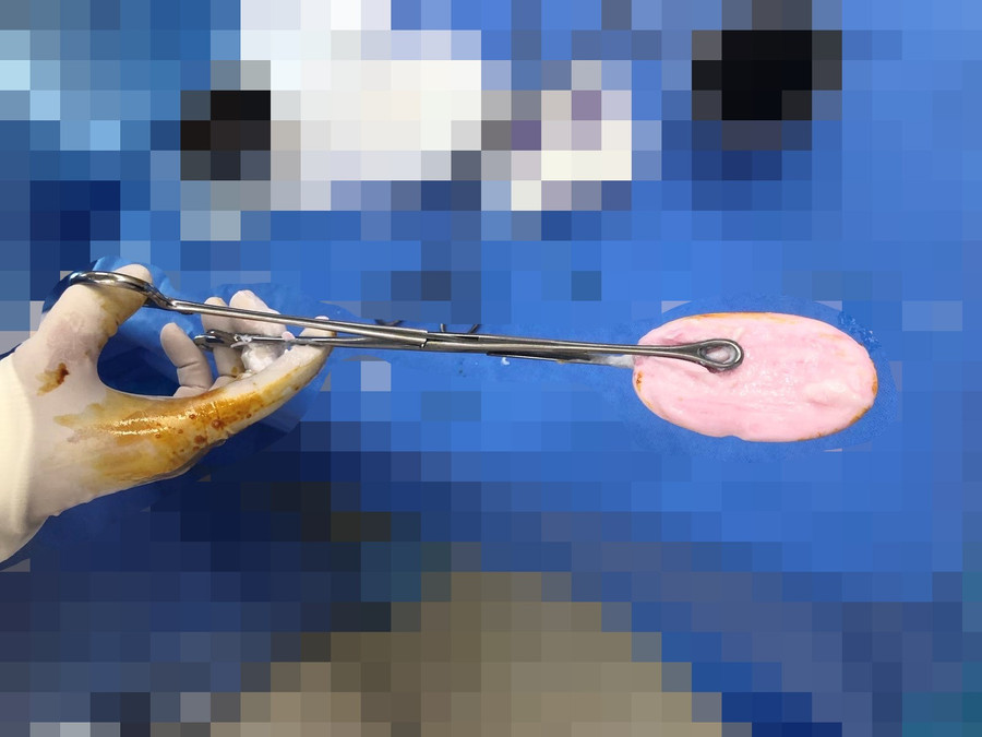 Cục xà phòng được lấy ra từ âm đạo bé gái. (Ảnh: BVCC)