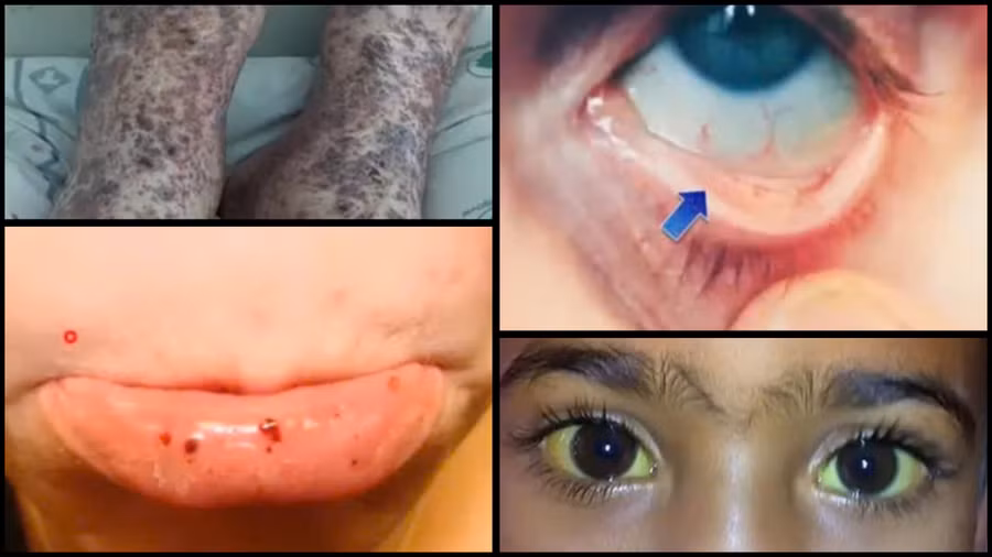 Các triệu chứng thường gặp của hội chứng Evans.