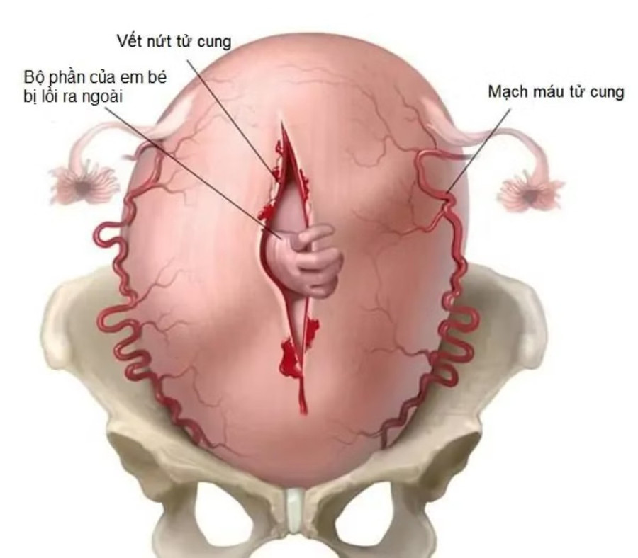 Vỡ tử cung là một tai biến sản khoa nghiêm trọng. (Ảnh minh họa: ITN) vo-tu-cung.jpg