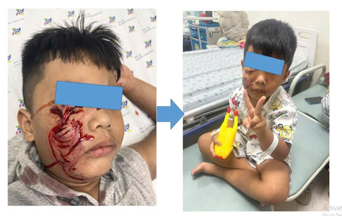 Bệnh nhi 5 tuổi bị chó cắn rách mặt.
