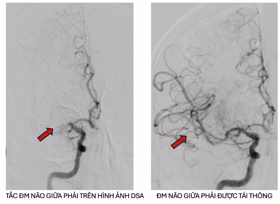 Hình ảnh chụp động mạch não cản quang trước và sau can thiệp lấy cục huyết khối cho thấy sự phục hồi tưới máu hoàn toàn. 