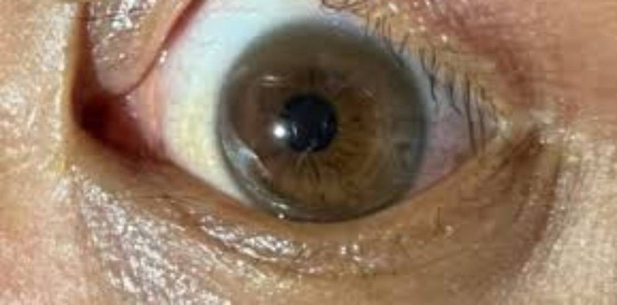 Một vòng màu nâu ở rìa giác mạc (Kayser – Fleischer ring) thường gặp ở bệnh Wilson, đặc biệt khi có các triệu chứng thần kinh. (Ảnh: ITN) images-2-1.jpg