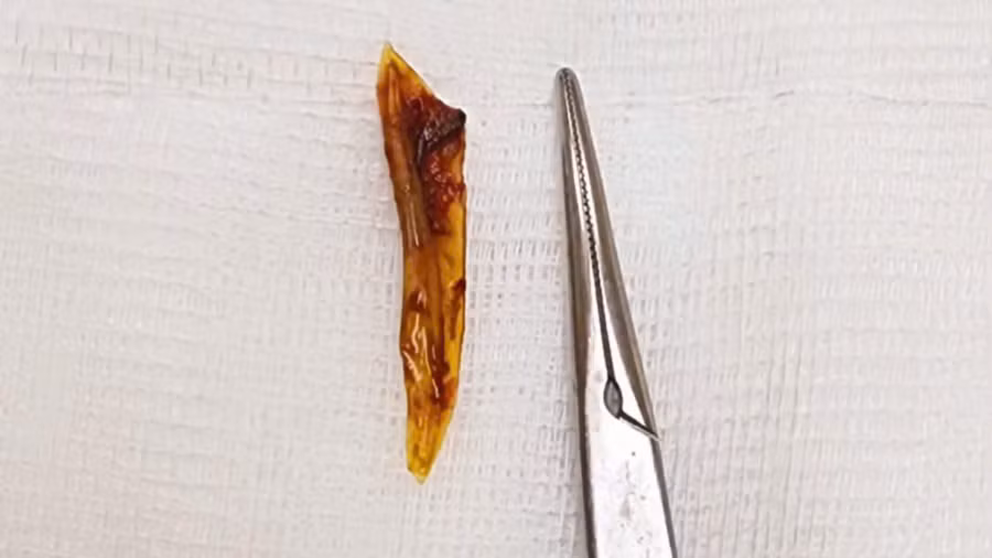 Hình ảnh xương cá gây thủng ruột cụ ông. (Ảnh: BVCC)