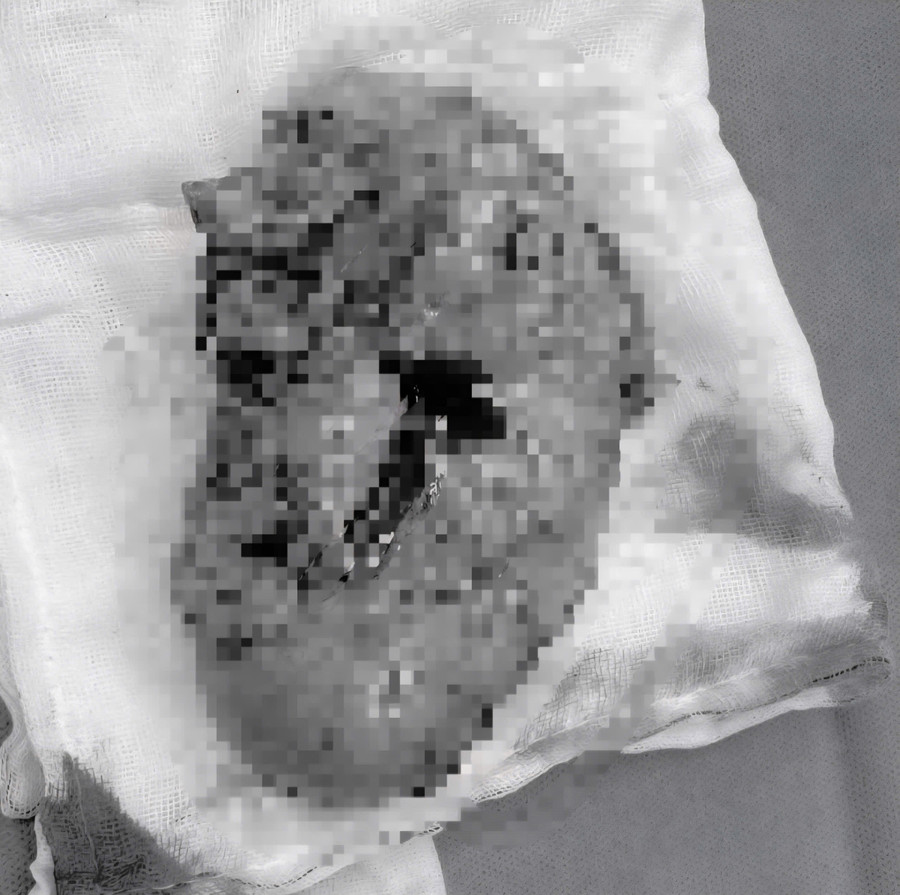 Các bác sĩ nhận định khối u rất to, ở vị trí khó. z7174878170559-f34bd19fef140e0654a1b869e3c22c35.jpg