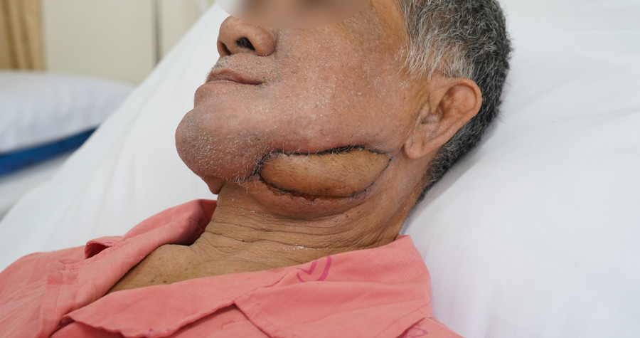 Hình ảnh bệnh nhân sau phẫu thuật. (Ảnh: BVCC) hinh-anh-sau-mo-805.jpg