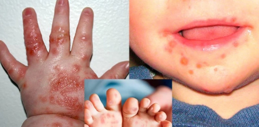 Biểu hiện điển hình của bệnh tay chân miệng ở trẻ. (Ảnh; INT)