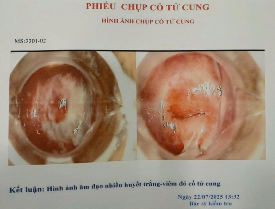 Hàng trăm hình ảnh chụp cổ tử cung bệnh lý, có mã số (ký hiệu MS) có sẵn trong máy tính tại Phòng khám đa khoa của Công ty TNHH Tập đoàn Việt Khang. e55259b47ddff481adce.jpg