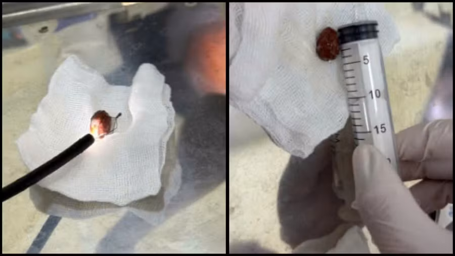 Cụ ông nguy kịch khi ăn xí muội