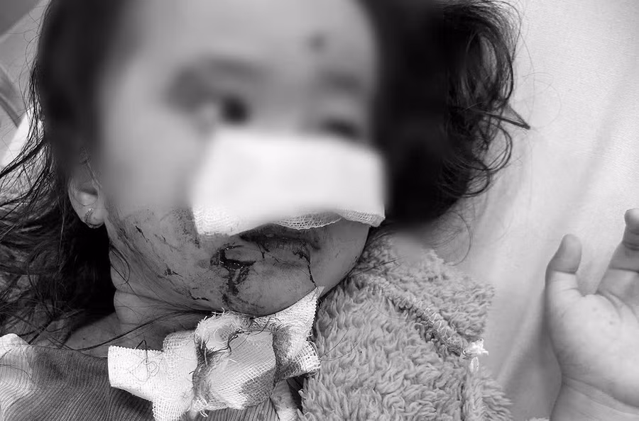 Bé gái bị chó cắn khi đang chơi ở công viên. 