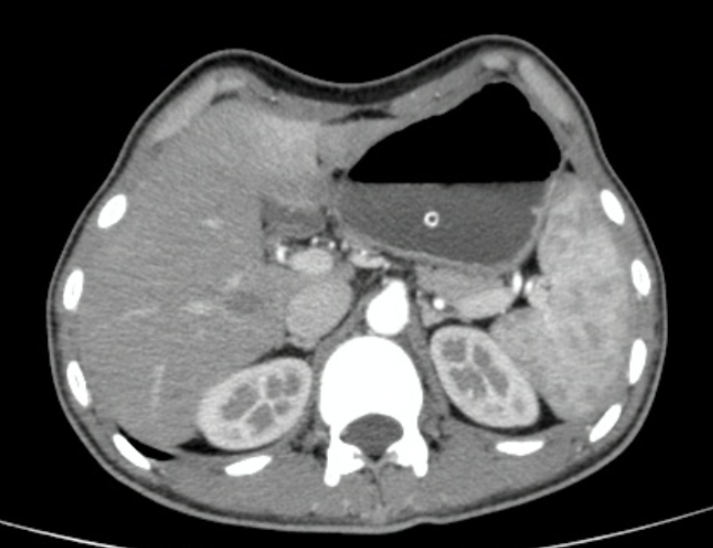 Hình ảnh CT bụng lõm lòng thuyền của bệnh nhân. bung-lom-long-thuyen.png