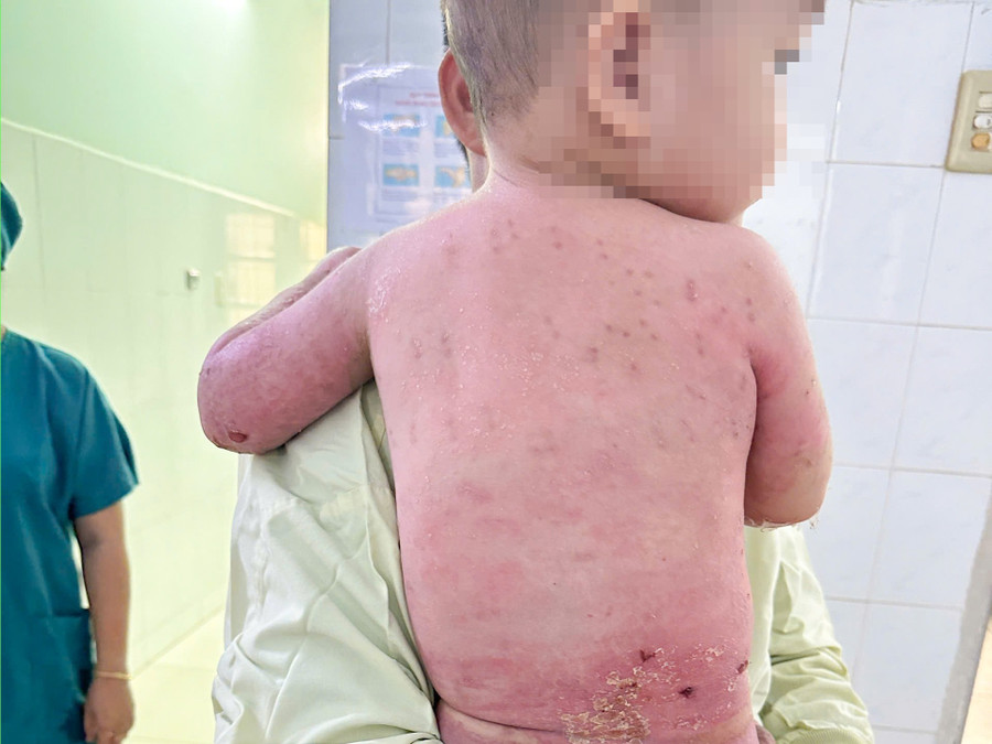 Hình ảnh bệnh nhi trước ngày xuất viện, vết bỏng hồi phục rõ rệt. hinh-anh.jpg