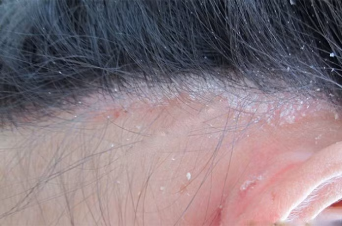 Vảy nến da đầu gây ngứa ngáy khó chịu cho người bệnh