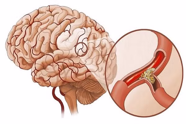 Nhồi máu não: Nguyên nhân, dấu hiệu cảnh báo sớm và cách phòng ngừa hiệu quả ảnh 1 Nhồi máu não: Nguyên nhân, dấu hiệu cảnh báo sớm và cách phòng ngừa hiệu quả ảnh 1
