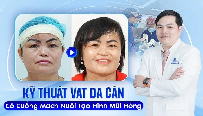 Sửa mũi hỏng tạo hình cánh mũi bằng kỹ thuật vạt da cân có cuống mạch nuôi