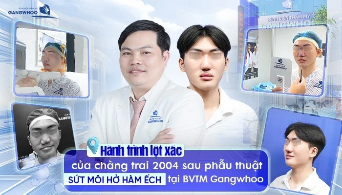 Chuyển vạt da giúp điều trị hở hàm ếch tạo hình mũi