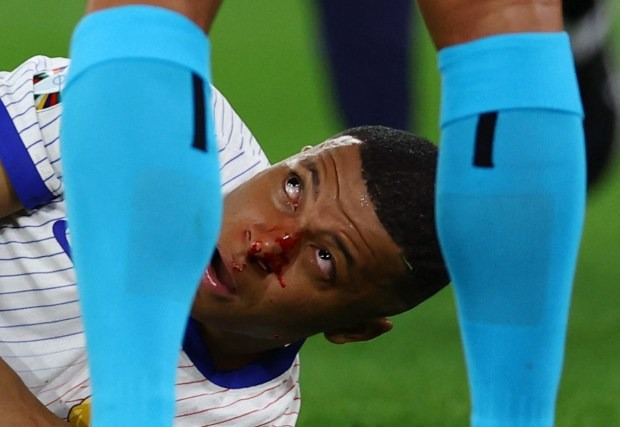 Chùm ảnh: Mbappe gãy xương mũi, phải đeo mặt nạ ở EURO 2024 