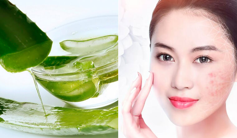 Thần dược tự nhiên trị mụn, chị em nào cũng cần 