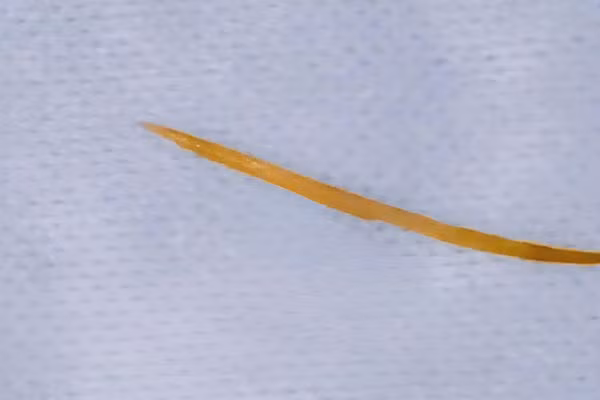 Xương cá dài 5cm được phát hiện khi bệnh nhân đi khám.
