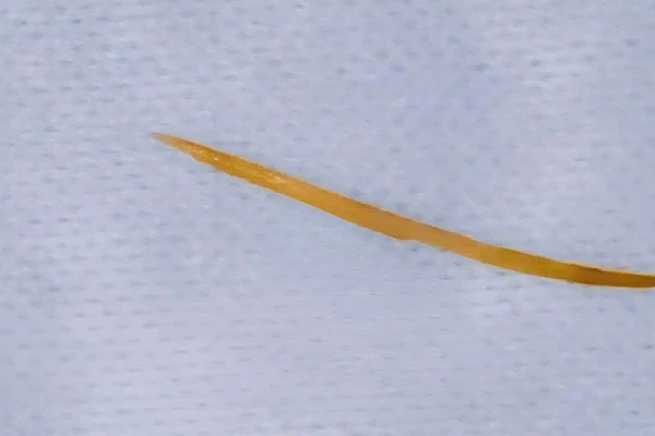 Xương cá dài 5cm được phát hiện khi bệnh nhân đi khám.