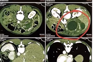 Hình ảnh phim chụp CT scan ổ bụng của bệnh nhân T.K. 