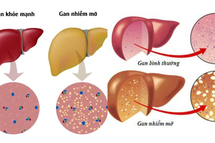 Gan nhiễm mỡ, tránh ăn gì?