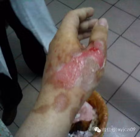 BS huong dan cach xu ly khi bi bong, hay luu lai loi khuyen nay - Anh 4