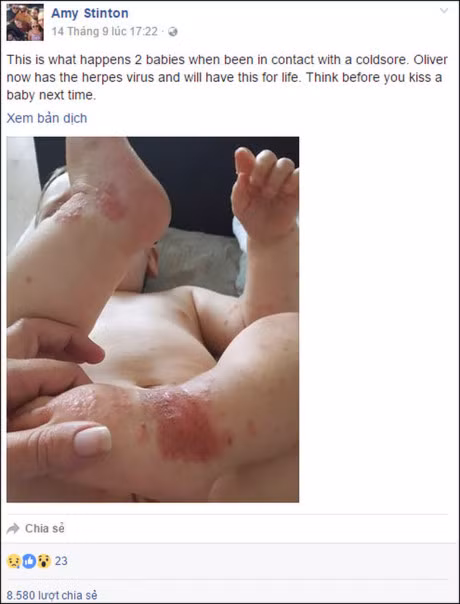 14 thang tuoi bi nhiem virus Herpes ca doi do nu hon tu nguoi lon - Anh 3