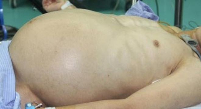 Người đàn ông mang thai anh em sinh đôi