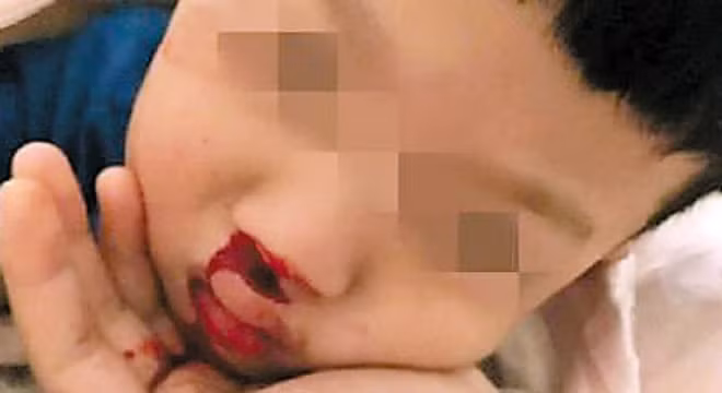 Một nạn nhân nhí trong vụ "ngộ độc đường chạy thể dục" ở Thượng Hải.