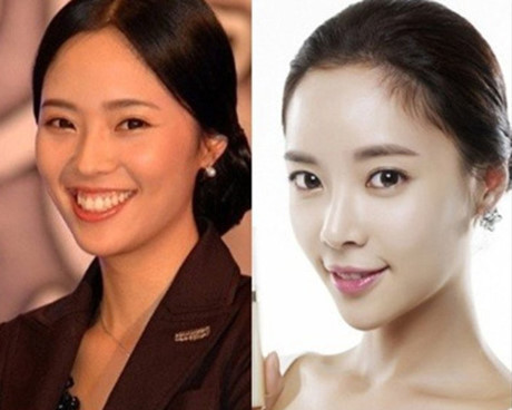 Sao Hàn lên đời nhan sắc nhờ chỉnh răng - Ảnh 7 Sao Han len doi nhan sac nho chinh rang - Anh 7