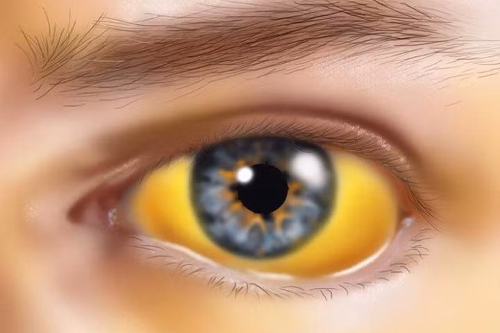 6 dấu hiệu cảnh báo gan gặp vấn đề