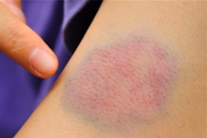 Nếu không va đập thì đây có thể là dấu hiệu của bệnh về máu. Ảnh: Internet.