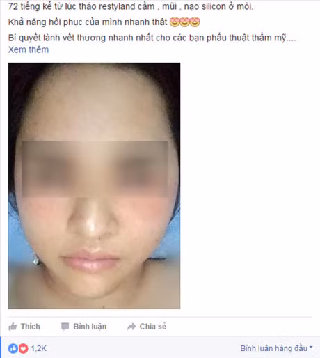 Loi khuyen gui chi em cua co gai Ha Noi vua tham my xong lai chiu dau de go het don cam, thao mui, nao silicon o moi - Anh 3