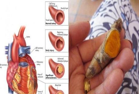 Ngăn ngừa đột quỵ, bảo vệ tim mạch với công thức siêu cường từ nghệ - Ảnh 1 Ngan ngua dot quy, bao ve tim mach voi cong thuc sieu cuong tu nghe - Anh 1