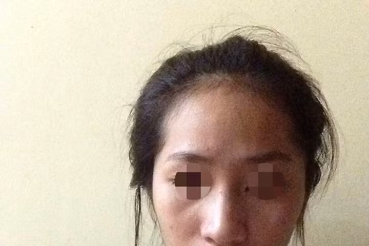 Bơm môi và những hệ lụy khôn lường mà bạn nên phòng trước