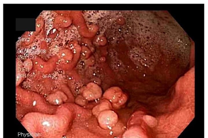 Hình ảnh polyp đại trực tràng 