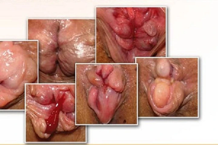 Mẹo chữa bệnh trĩ tại nhà