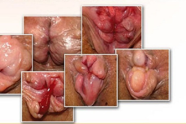 Mẹo chữa bệnh trĩ tại nhà