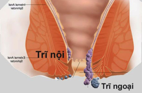 Mẹo chữa bệnh trĩ tại nhà - Ảnh 1 Meo chua benh tri tai nha - Anh 1