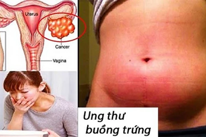 Dấu hiệu nhận biết ung thư buồng trứng sớm cho mọi lứa tuổi