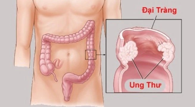 Ung thư trực tràng nguy hiểm thế nào?