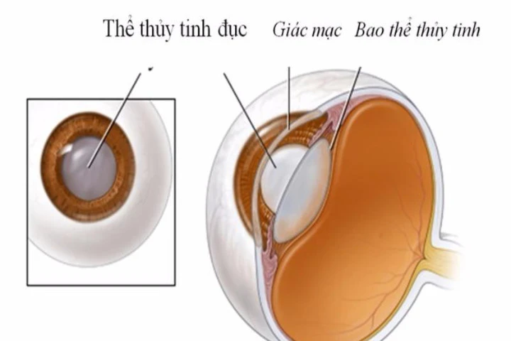 Bệnh đục thủy tinh thể và biện pháp phòng ngừa