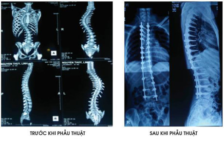 Cô gái 19 tuổi đã có thể tự tin bước đi sau 5 năm dài sống chung với căn bệnh vẹo xương cột sống - Ảnh 1 Co gai 19 tuoi da co the tu tin buoc di sau 5 nam dai song chung voi can benh veo xuong cot song - Anh 1