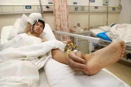 Ghép tay phải vào chân trái để cứu bàn tay