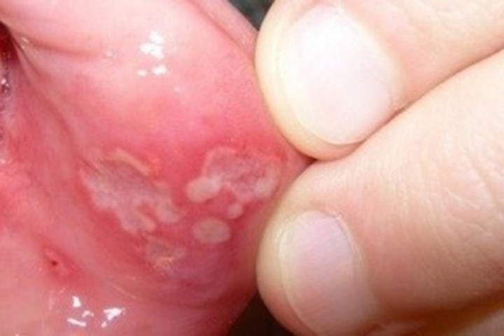 Mẹo chữa nhiệt miệng cực nhanh mà không cần dùng thuốc tây