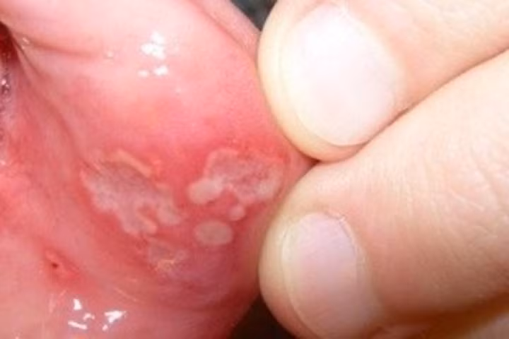 Mẹo chữa nhiệt miệng cực nhanh mà không cần dùng thuốc tây