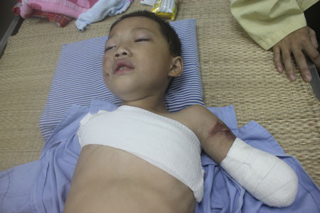 Bé 5 tuổi bị gấu nuôi cắn nát 2 tay 2 Bé 5 tuổi bị gấu nuôi cắn nát 2 tay 2